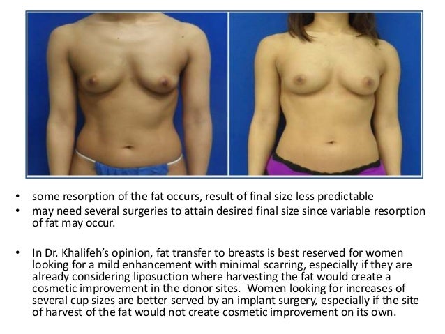 fat for breast augmentation Fat for breast augmentation